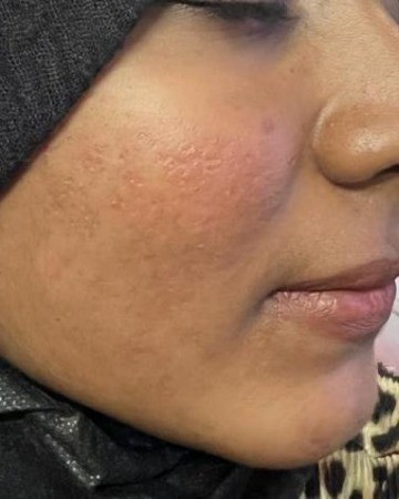 After Acne Treatment