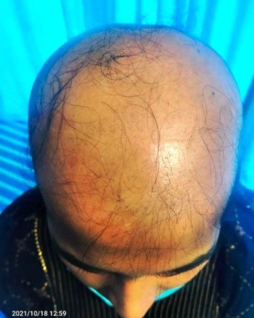 Before Hair Transplant