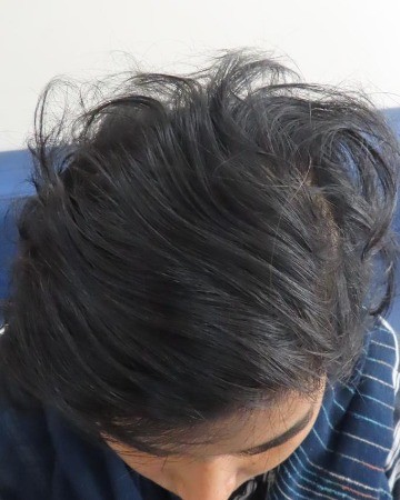 After Hair Transplant
