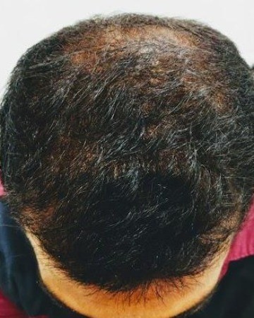 Before Hair Transplant