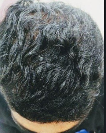 After Hair Transplant