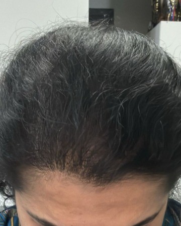 After Female Hair transplant