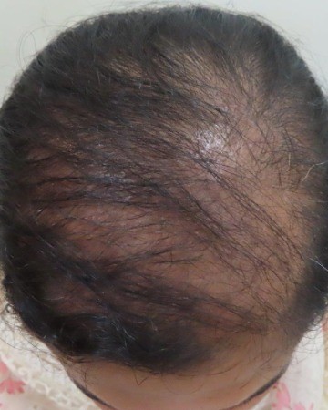 Before Female Hair transplant
