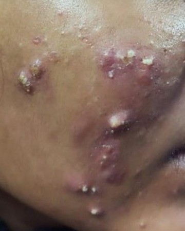 Before Active Acne – Clearer Skin after Medical Treatment
