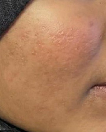 After Active Acne – Clearer Skin after Medical Treatment