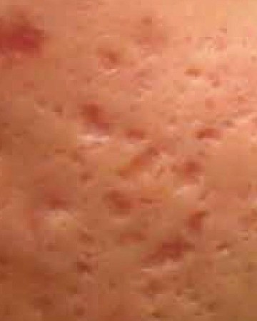 Before Acne Scars – Improvement with Chemical Peels