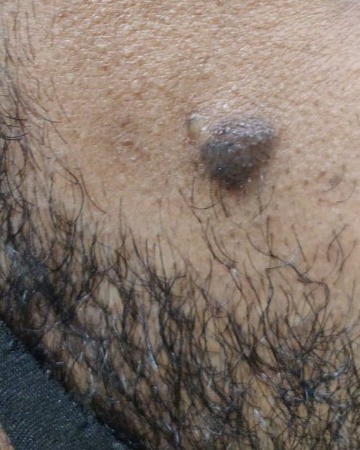 Before Mole Removal – Cheek