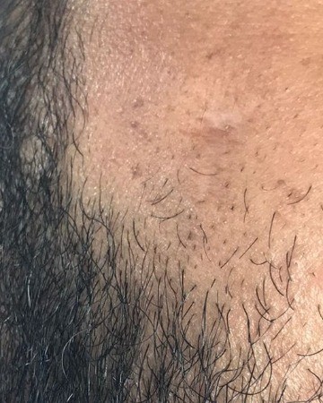 After Mole Removal – Cheek