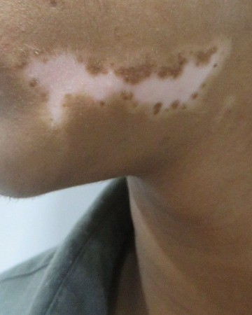 Before Vitiligo Surgery – Repigmentation of Chin Patch