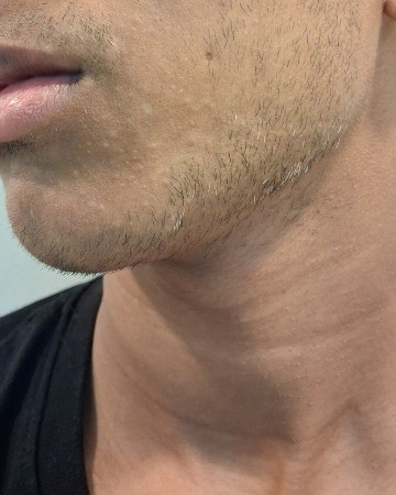 After Vitiligo Surgery – Repigmentation of Chin Patch