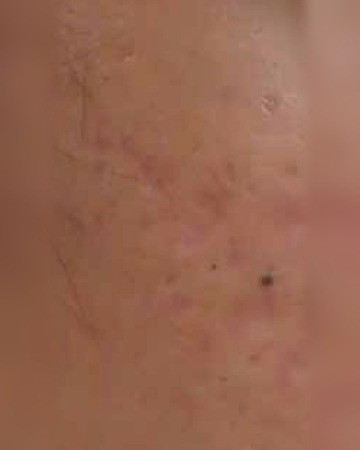 After Acne Scars – Improvement with Chemical Peels