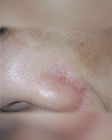 After Skin Tumour Removal – Nose