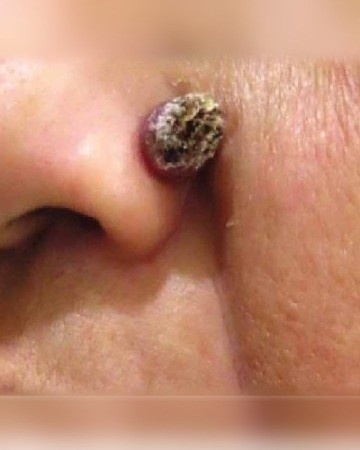 Before Skin Tumour Removal – Nose